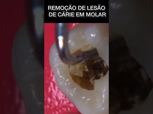 REMOÇÃO DE CÁRIE DENTAL #oral #bucal #lesaodecarie #bucal #shortsfeed #shortsviral #carie #odontolog