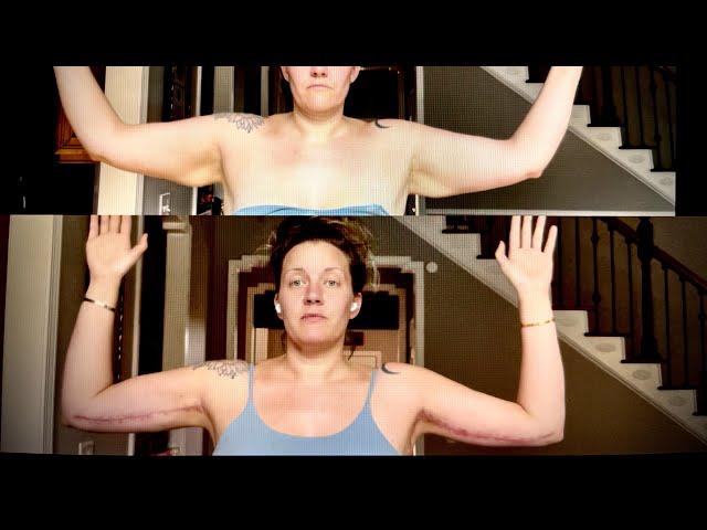 Brachioplasty (Arm Lift) before and after | 3day, 3wk, & 8wk recovery progress | PCOS weightloss