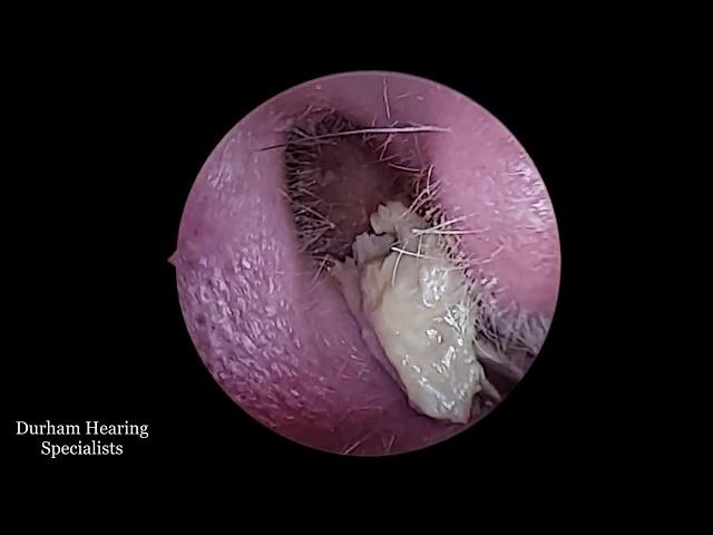 White fungal infection in ear revealed after wax and dead skin removal