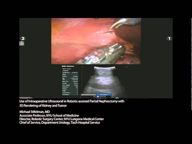 BK Medical: Robotic-assisted Partial Nephrectomy with 3D Rendering by Michael Stifelman, MD.