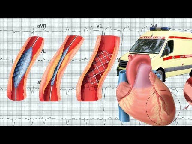 Стентирование сосудов сердца, лечение инфаркта миокарда