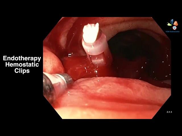 Mr. Kumar Patient Endotherapy Hemostatic Clips Video