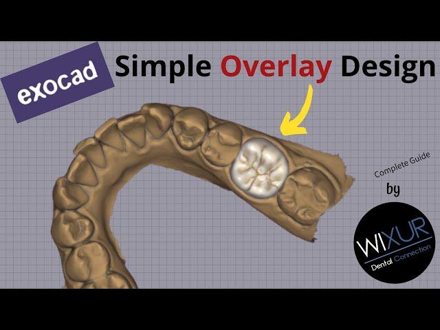 Simple Overlay Design in exocad