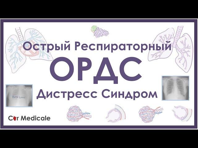 Острый респираторный дистресс синдром - ОРДС - механизм развития, причины, патофизиология