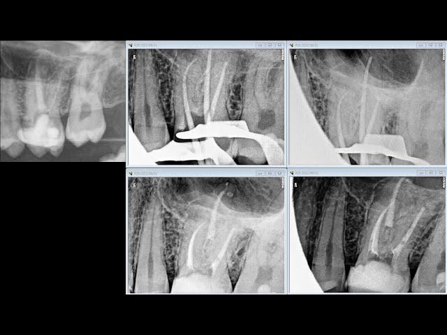 Upper molar retreatment