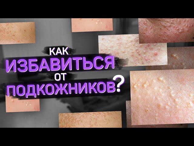 Подкожники. Что такое и как от них избавиться?