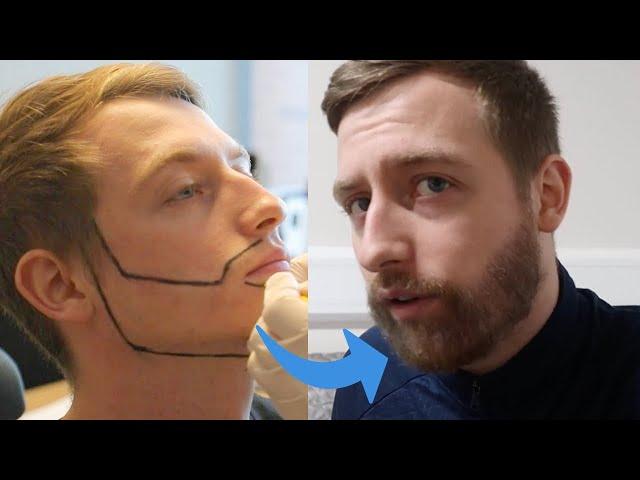 Beard Transplant - Jay´s Complete journey to a Full Beard (before / after)