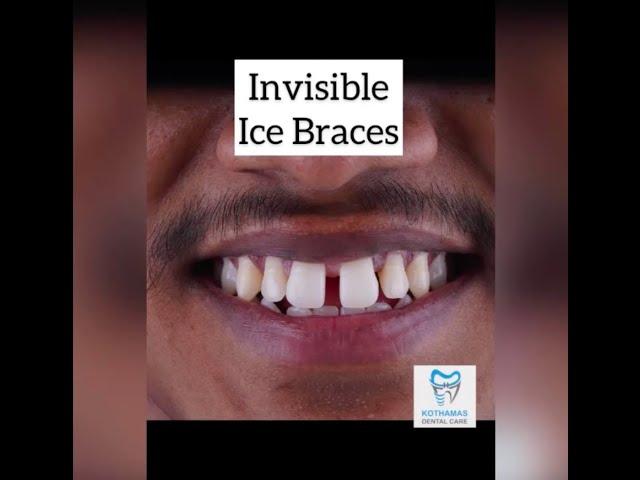 How braces are put on - Crystal clear braces #shorts