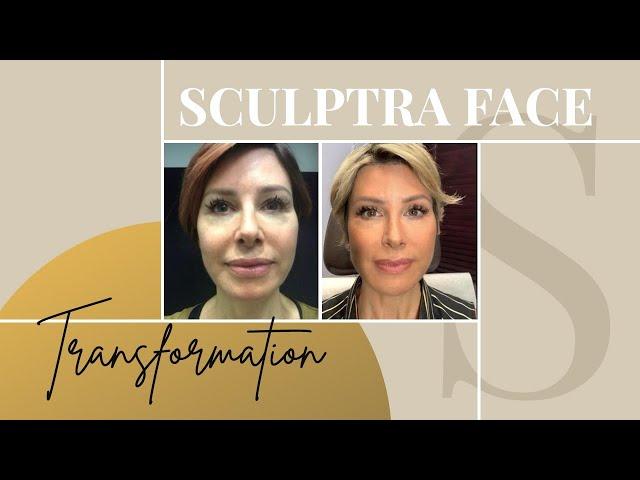 Sculptra Before & After | My Review on the Non-Surgical Facelift | Dominique Sachse