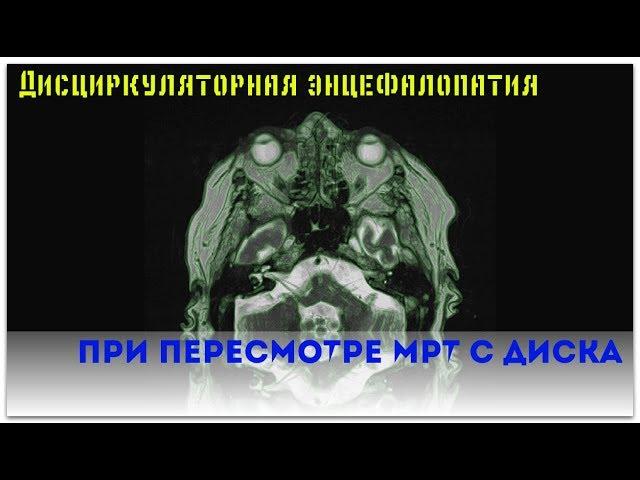 Заключение МРТ головного мозга показало дисциркуляторную энцефалопатию