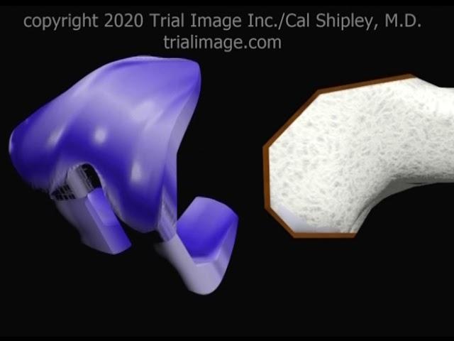 Total Knee Replacement Surgery Animation by Cal Shipley, M.D.