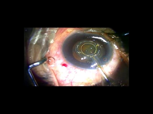 Zepto Cataract Surgery First Time