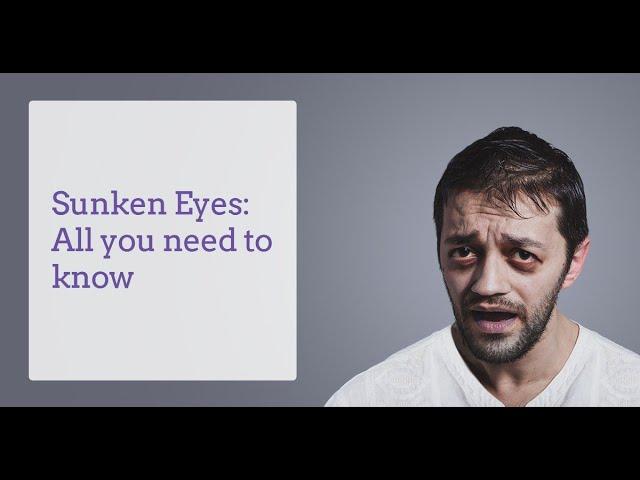 How to get rid of sunken eyes  How to get rid of sunken eyes naturally New Video