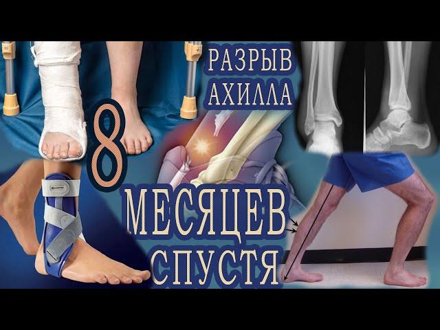 РАЗРЫВ АХИЛЛА СПУСТЯ 8 МЕСЯЦЕВ