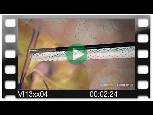 DynaMesh®-ENDOLAP 3D - Animation: TAPP Technique for Treatment of Inguinal Hernia