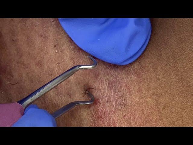 Vajacial Ingrown Hair Removal