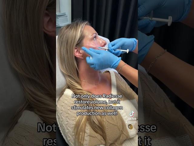 Radiesse Cheek Filler at Dermfx Medspa!