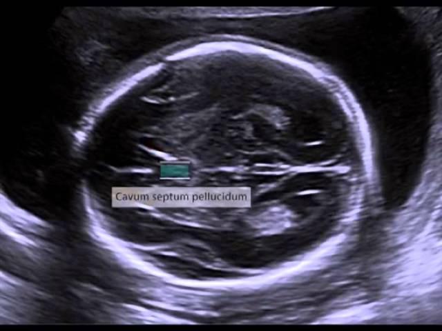 Transventricular View