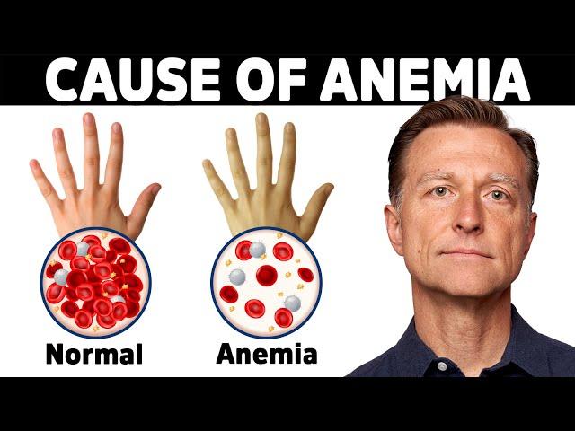 The Hidden Cause of Anemia You've Never Heard About