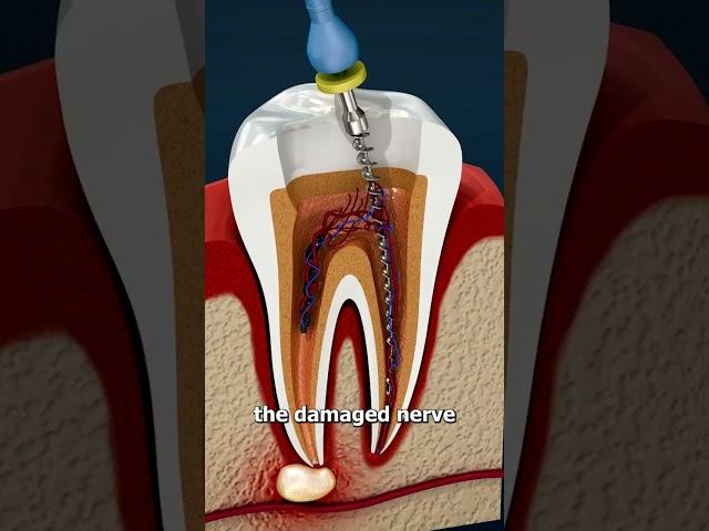 What Is A Root Canal? 