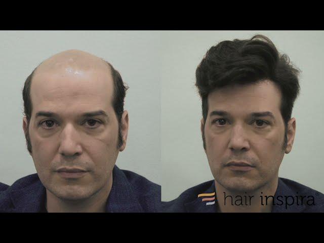 Aplicación prótesis capilar indetectable - Hair Replacement fitting video (Pablo) - Hair Inspira