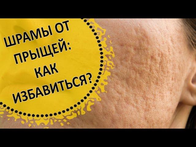 Как Убрать Шрамы от Прыщей (Постакне)