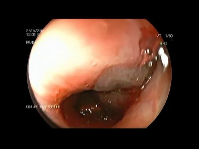 Managing Live Leech and Roundworm Endobronchial Infestation