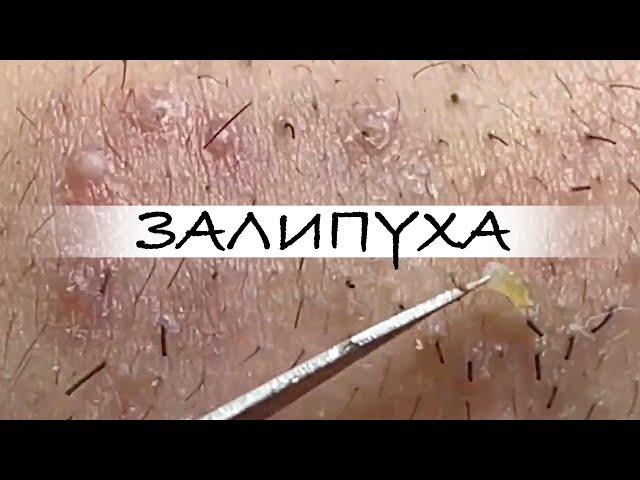 ПРЫЩИ  ПРЫЩИ ВЫДАВЛИВАНИЕ  ПОДБОРКА ВЫДАВЛИВАНИЕ ПРЫЩЕЙ #прыщи #acne #asmr #прыщиналице