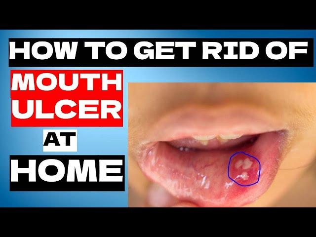 5 Amazing Home Remedies to Get Rid of A Mouth Ulcer Fast | Mouth Ulcer Treatment At Home