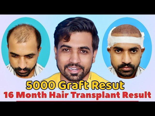 Hair Transplant Result in India | Average Cost Hair Transplant Result |  Diet Care