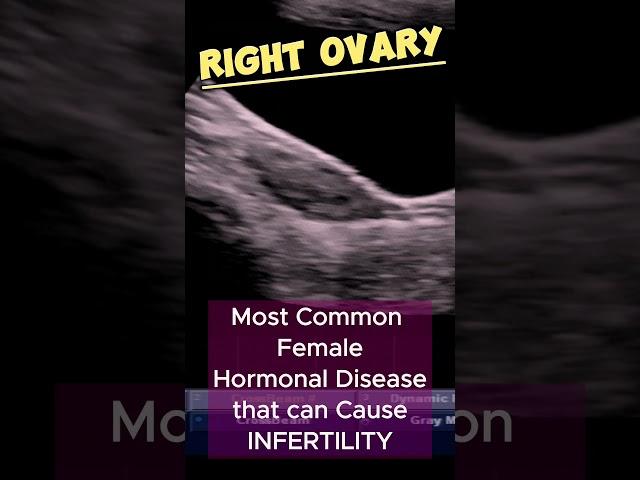 PCOS - Polycystic Ovaries | PCO - TVS Ultrasound