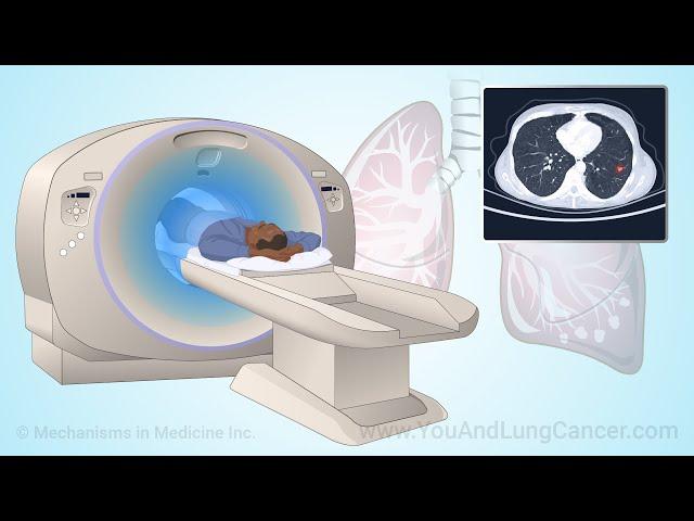 Screening for Lung Cancer