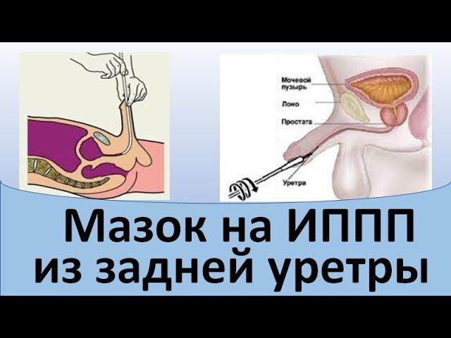 Мазок на ИППП из задней уретры