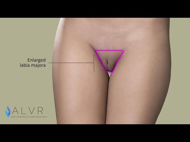 Labia Majora Reduction Animation - Front View