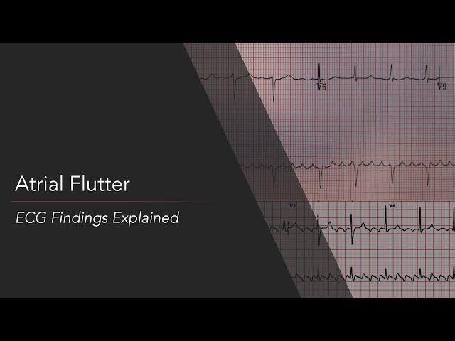 Atrial Flutter: ECG Findings Explained