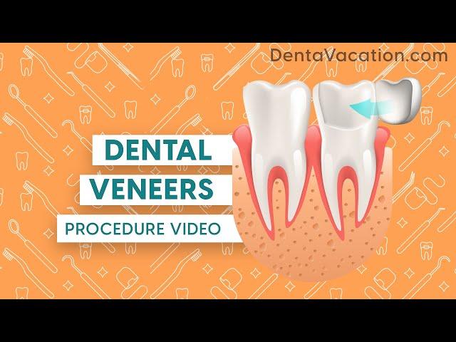 Dental Veneers Procedure Abroad | DentaVacation