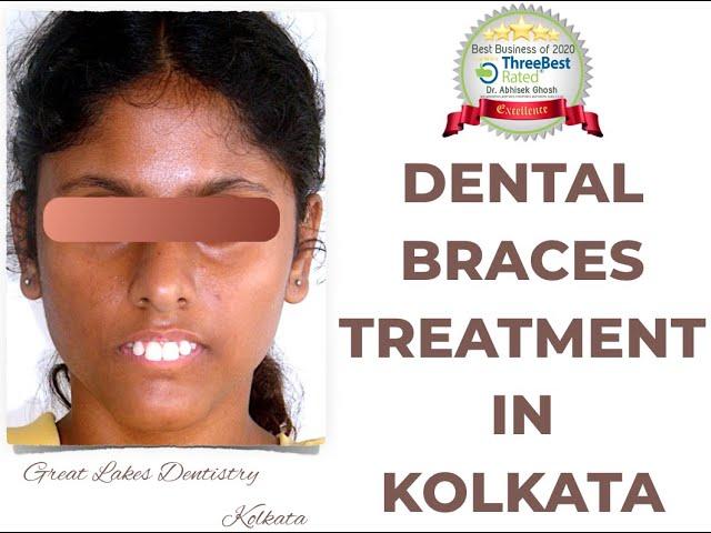 Dental Braces Procedure | Best Dental Braces Clinic in Kolkata | Orthodontic Treatment in Kolkata