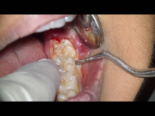 Wisdom Tooth Extraction Without Forceps (E.W.F.) | Dr. Fabio Cozzolino, Zerodonto