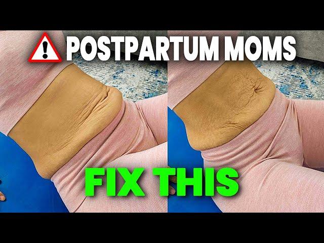 Diastasis Recti CONING: How to Fix It in 3 Simple Steps