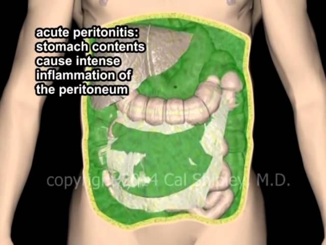 Peritonitis with Gastric perforation animation by Cal Shipley, MD.