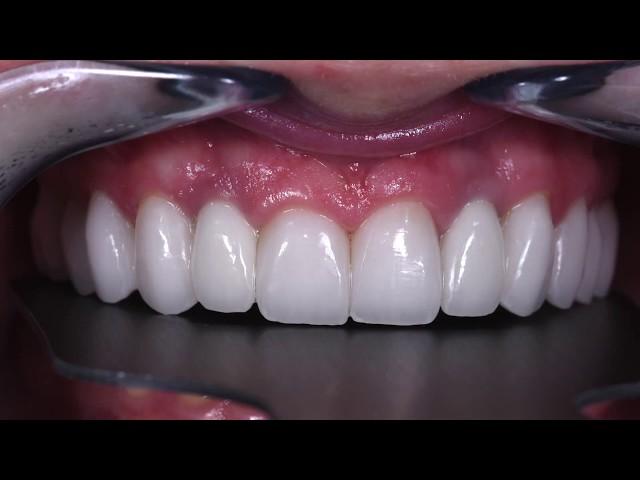 Dental Implants Procedure in Midtown NYC - Dr. Alex Rubinov - Cosmetic Dentist in NYC