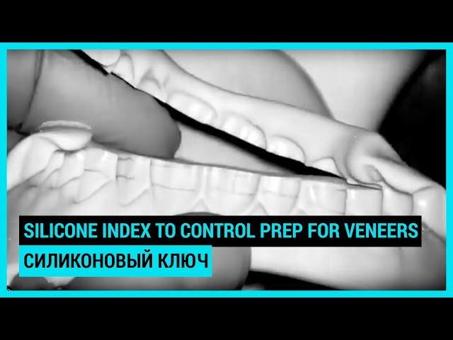 Silicone index to control prep for veneers. Силиконовый ключ