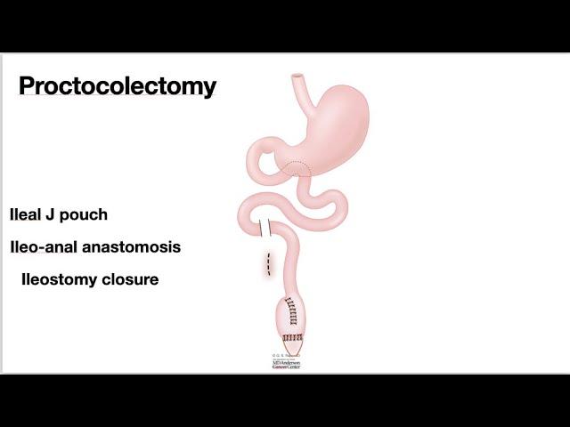 HCC 1475 10m  Surgical Anatomy Proctocolectomy