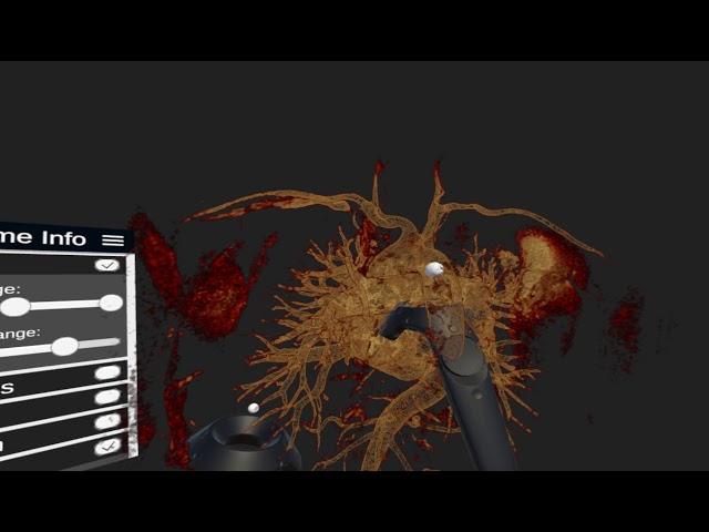Babel VR - Abdominal Aortic Aneurism Planning