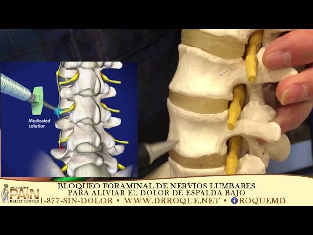 Selective Lumbar Foraminal Block, L2-L3