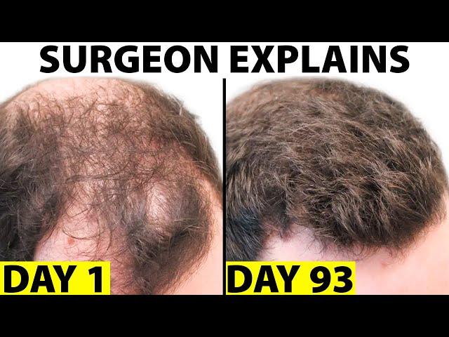 Oral Minoxidil - A Better Hair Loss Treatment?