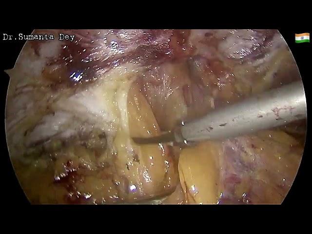 Ventral Hernia & Diastasis Recti: Laparoscopic eTEP RS repair by Dr.Sumanta Dey