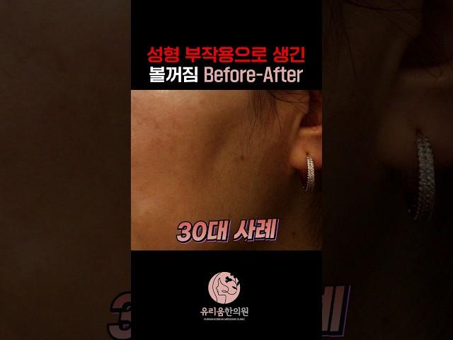 성형수술 보톡스로 생긴 볼꺼짐 시술 전후