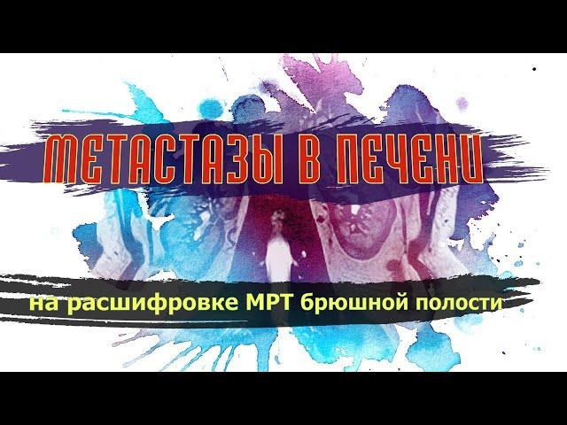 МЕТАСТАЗЫ печени, АКСИЛЛЯРНАЯ ЛИМФАДЕНОПАТИЯ подмышечных лимфоузлов  РАСШИФРОВКА МРТ брюшной полости