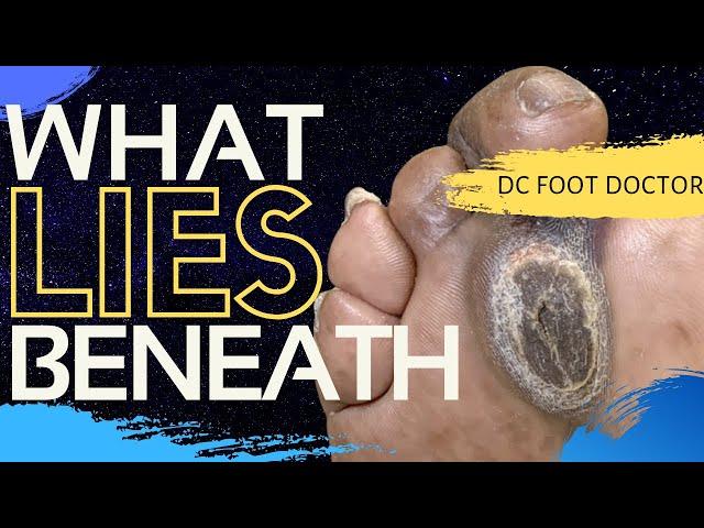 What Lies Beneath: Callus with an Ulcer